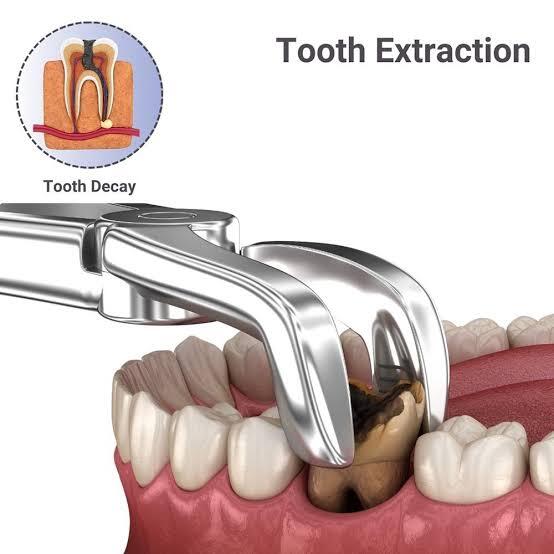 Pediatric Dentistry (Kids RCT with Crown) thumbnail